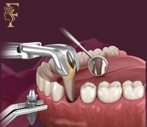 خلع ضرس بدون جراحة