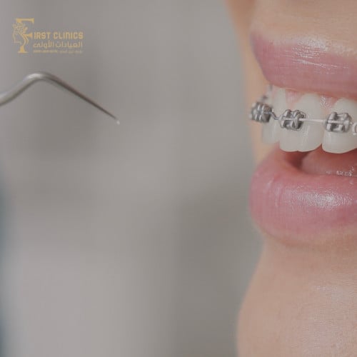 مثبت فك متحرك