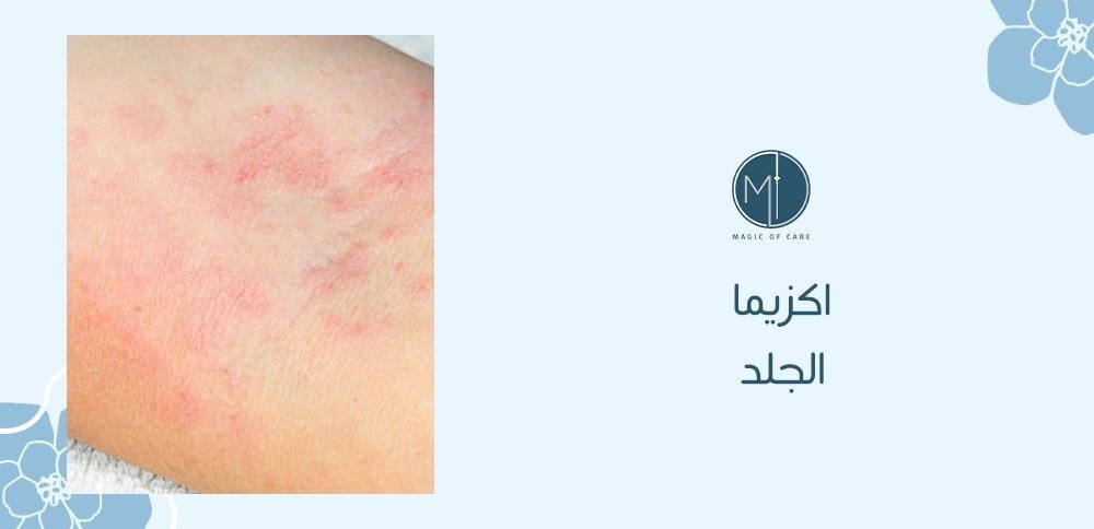 اكزيما الجلد
