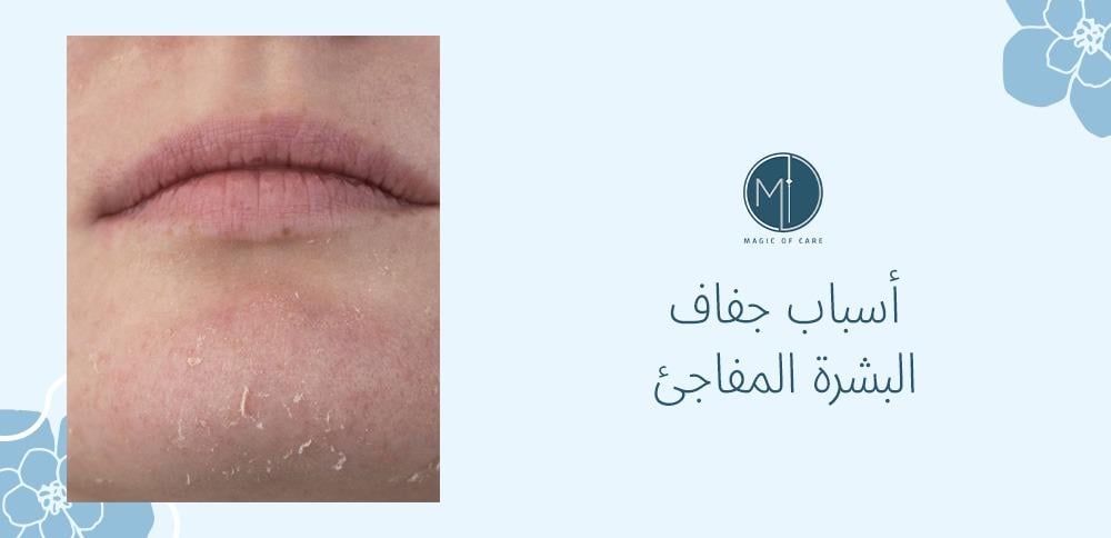 أسباب جفاف البشرة المفاجئ