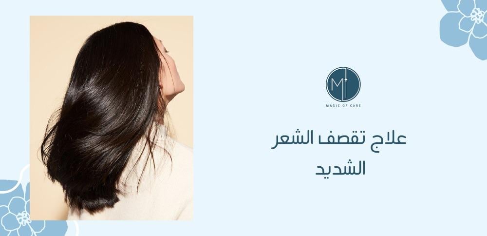 علاج تقصف الشعر الشديد