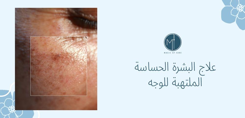 علاج البشرة الحساسة الملتهبة للوجه