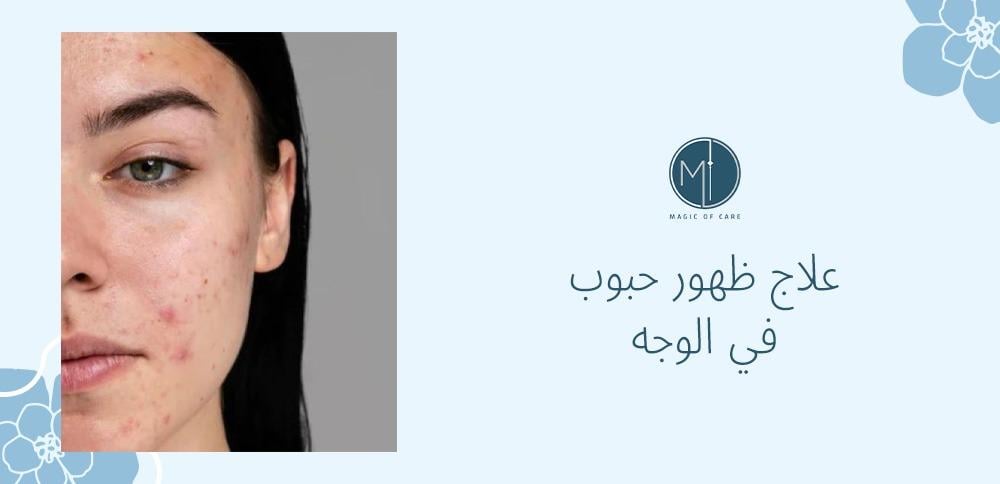 علاج ظهور حبوب في الوجه