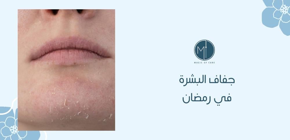 جفاف البشرة في رمضان