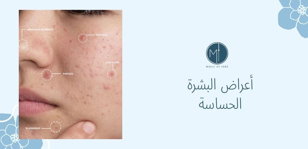 أعراض البشرة الحساسة