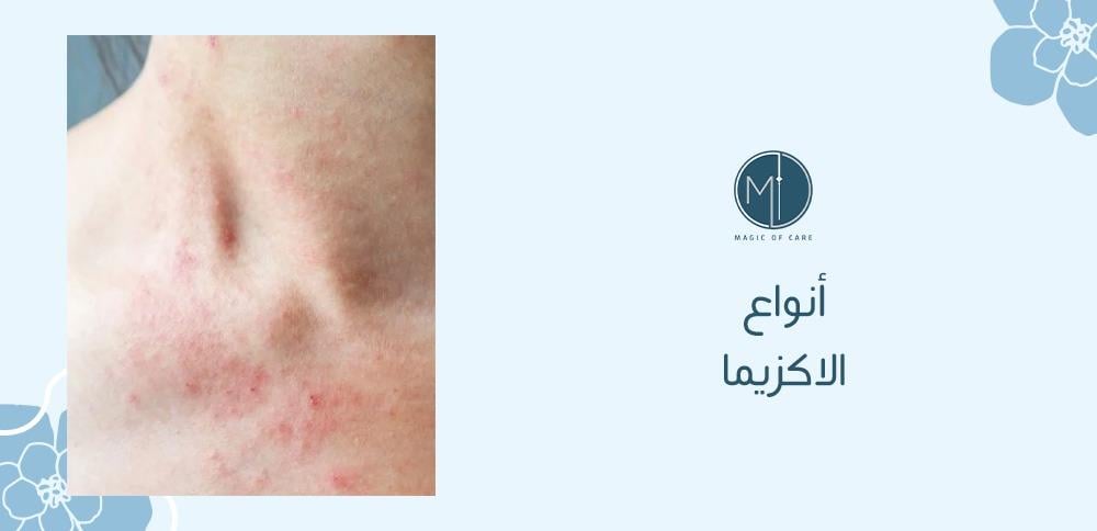 انواع الاكزيما