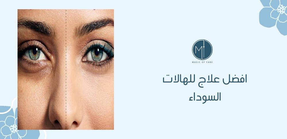 افضل علاج للهالات السوداء