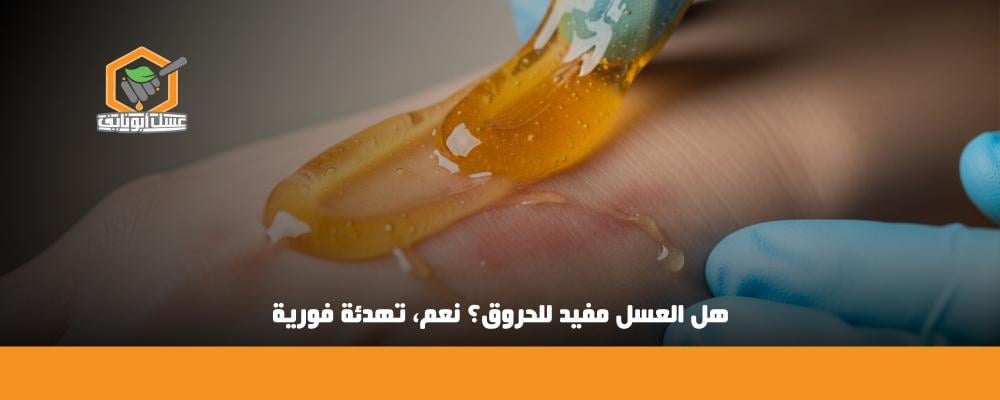 هل العسل مفيد للحروق