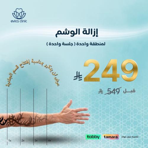 ازالة التاتو