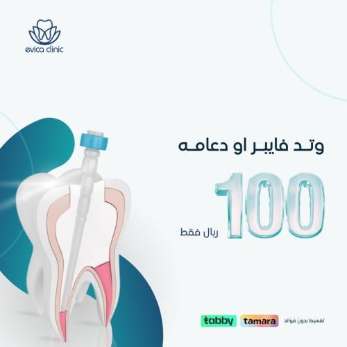 وتد او دعامه