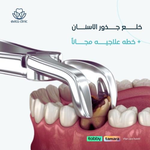 خلع جذور الأسنان + خطه علاجيه مجاناً