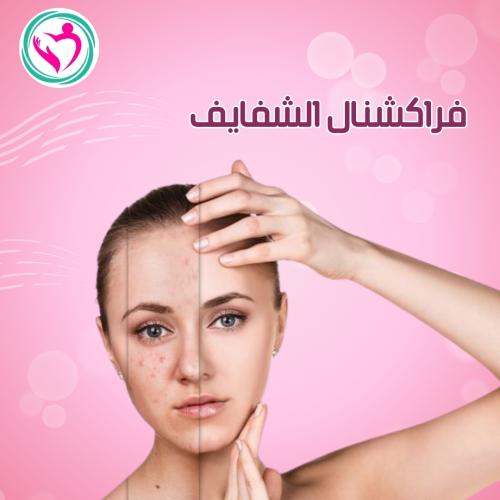 فراكشنال تفتيح الشفايف
