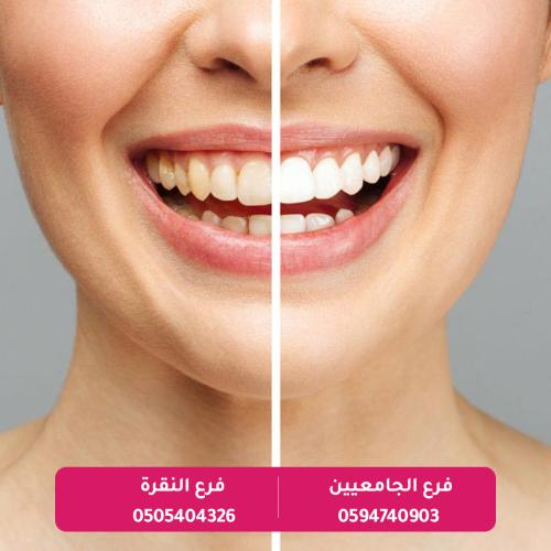 تبييض الاسنان